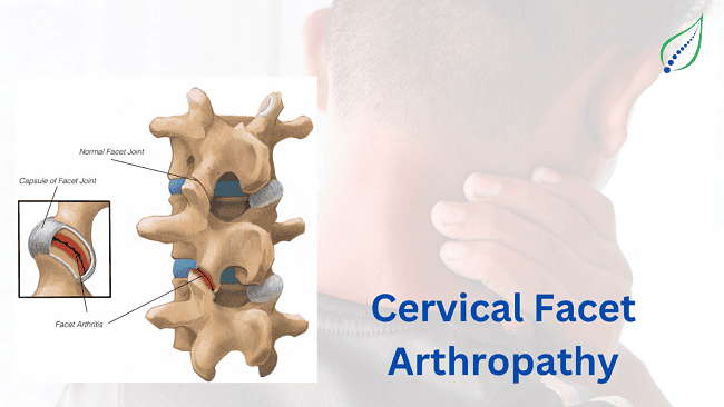Cervical Facet Arthropathy